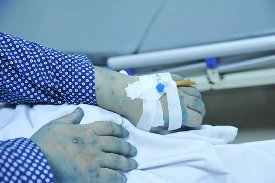 Lây thủy đậu từ con trai, người đàn ông 32 tuổi tử vong