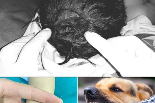 Bé 18 tháng tuổi ở Phú Thọ bị chó cắn lộ xương sọ