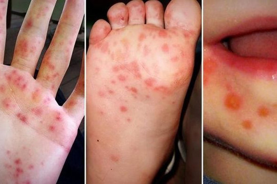 Đi bơi, trẻ có bị lây bệnh tay chân miệng không?