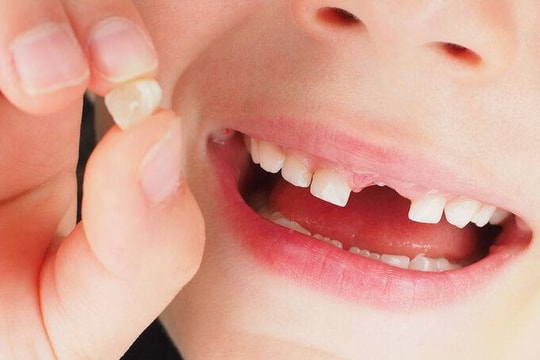 Sơ cứu răng rơi khỏi ổ đúng cách khi gặp tai nạn chấn thương răng