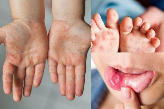 6 khuyến cáo cần nhớ của Bộ Y tế về bệnh tay chân miệng