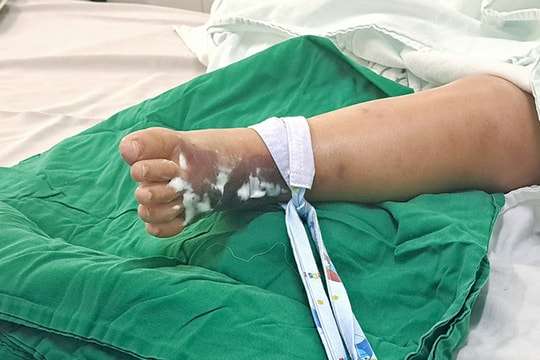 Bị rắn hổ mèo cắn, bé trai sốc nhiễm trùng, nhiễm độc toàn thân