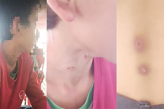 Một bé trai 14 tuổi nghi bị bố dượng bạo hành dã man ở An Giang