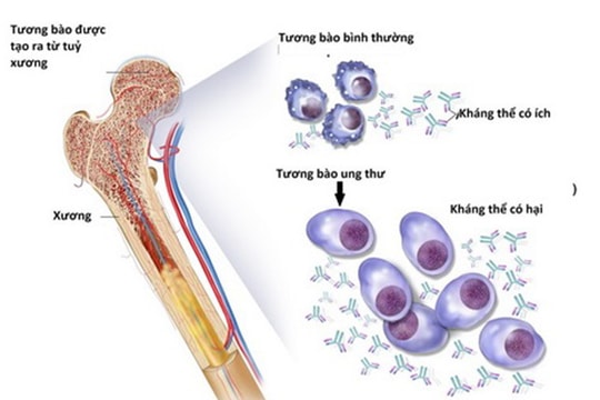 Phương thức điều trị bệnh đa u tủy xương mới dựa trên công nghệ RNA
