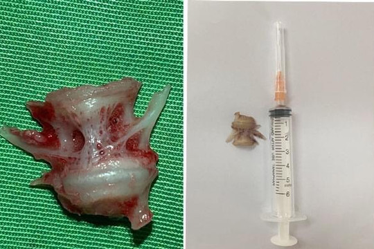 Nội soi gắp xương cá khủng trong thực quản một phụ nữ ở Kinh Môn