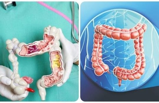 7 dấu hiệu ung thư đại tràng giai đoạn đầu dễ nhận biết nhất