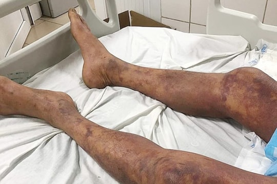 Bị sốc nhiễm khuẩn, suy đa tạng sau khi giết mổ và ăn thịt lợn ốm