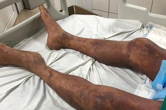 Người đàn ông tím đen cơ thể sau khi ăn thịt lợn ốm