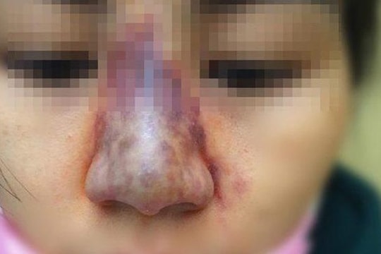 4 nguyên nhân dẫn đến biến chứng khi tiêm filler làm đẹp