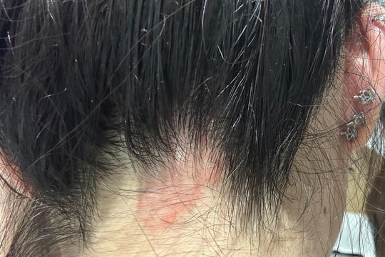 Kích ứng da bởi thuốc nhuộm tóc