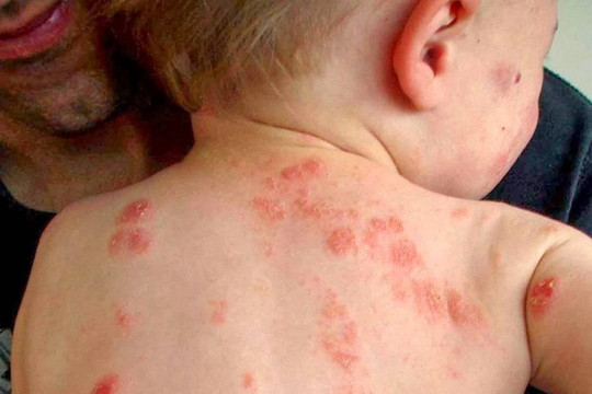 Cách hạn chế bệnh nhiễm trùng ở trẻ sơ sinh