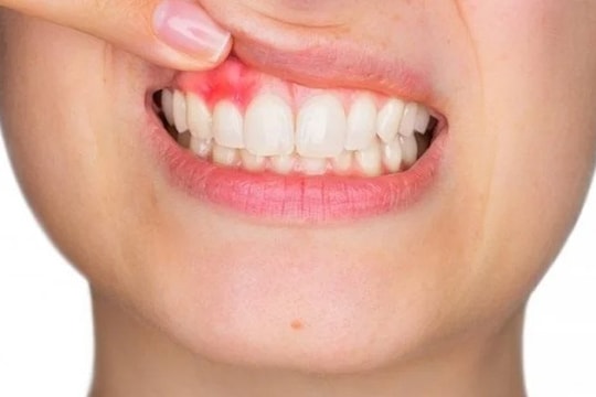 Dấu hiệu ở miệng cảnh báo gan nhiễm mỡ