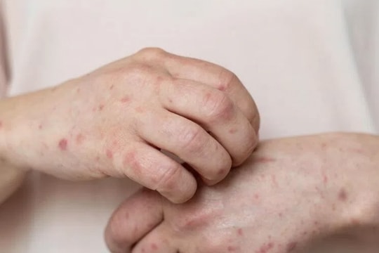 Đồng Nai ghi nhận ca mắc đậu mùa khỉ đầu tiên