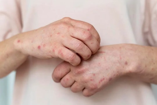 Chủ động khai báo khi có dấu hiệu nghi ngờ, mắc bệnh đậu mùa khỉ