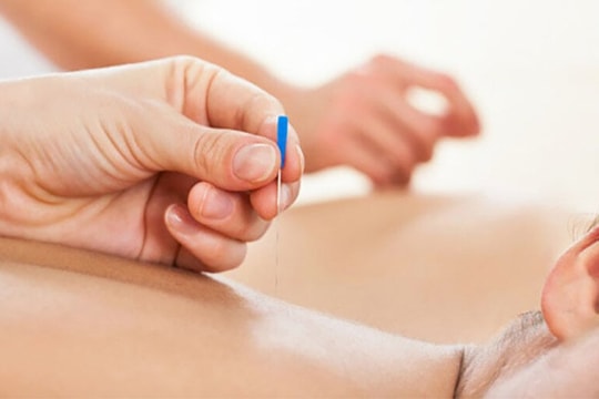 Làm đẹp, trị bệnh bằng phương pháp cấy chỉ