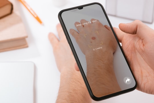 Công cụ AI có thể chẩn đoán đúng 99% ung thư da