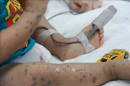 Bà Rịa-Vũng Tàu giám sát chặt chẽ các ổ bệnh tay chân miệng