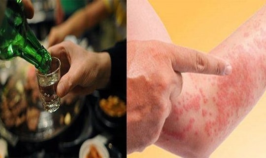 Vì sao uống rượu bia hay bị mẩn ngứa, mề đay?