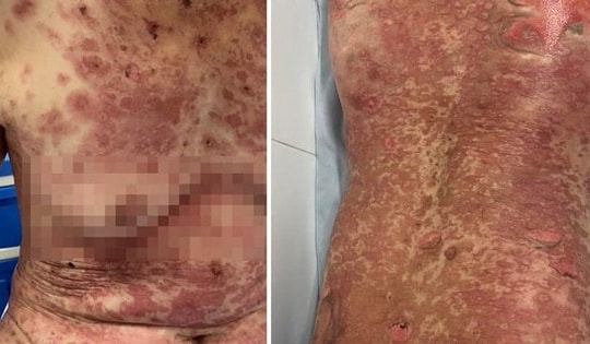 Tự ý dùng thuốc nam điều trị bệnh, nhiều trường hợp bị dị ứng nặng
