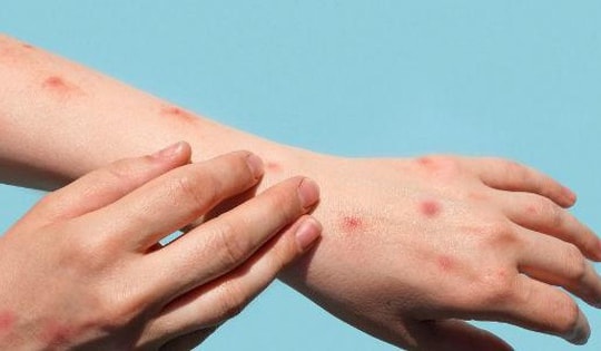56 ca đậu mùa khỉ tại Việt Nam, có tới 93% là nam giới