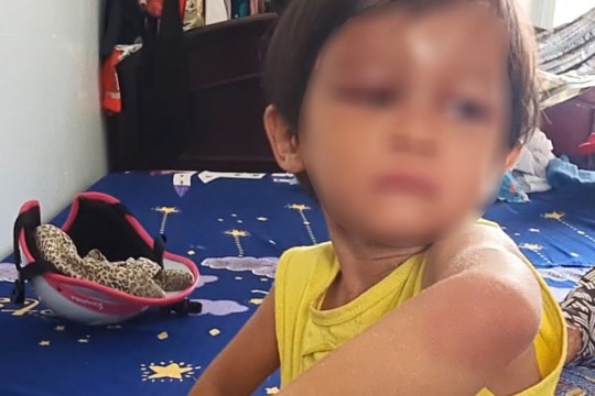 Bắt tạm giam cha nuôi bạo hành bé gái 4 tuổi ở Cà Mau