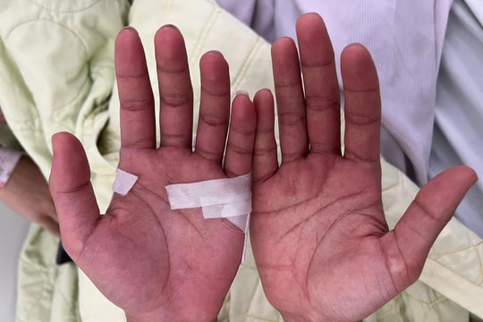 Sốt xuất huyết bị ngứa, mẩn đỏ ngoài da có bất thường?