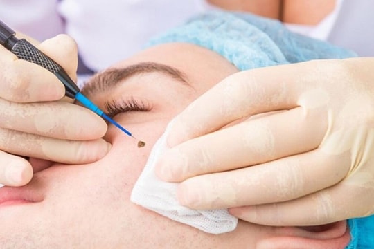 Có nên xóa nhiều nốt ruồi một lúc?