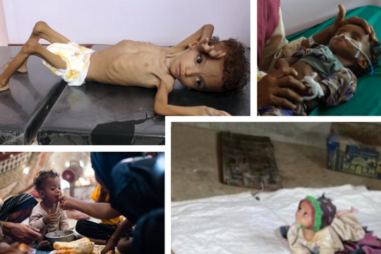 Quặn lòng trước cảnh trẻ em Yemen oằn mình trong nạn đói triền miên