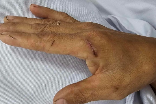 Nhiễm liên cầu lợn dù không ăn tiết canh