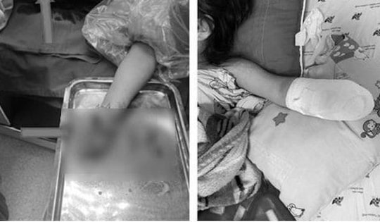 Hàng xóm đốt pháo, bé gái ở TP Hồ Chí Minh bị mất bàn tay