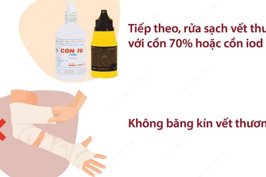 Cần làm gì ngay sau khi bị chó, mèo cắn để phòng bệnh dại?