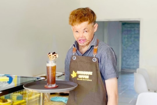 Bị bỏng biến dạng cơ thể, chàng trai ở Kon Tum hồi sinh sau 20 lần phẫu thuật