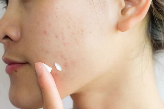 Những thói quen xấu gây mụn mà bạn nên tránh để có làn da khỏe đẹp