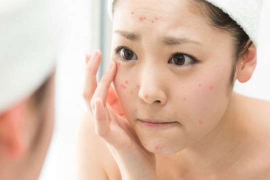 Hướng dẫn cách chăm sóc da mụn vào mùa hè