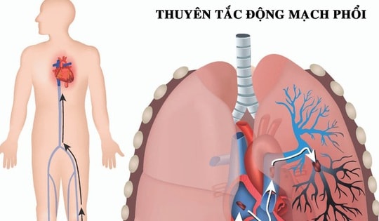 Cẩn thận bệnh "sát thủ ẩn mình" thuyên tắc động mạch phổi gây tử vong nhanh trong 1-2 giờ