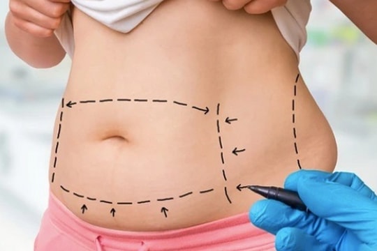 Hút mỡ bụng, cắt sẹo, người phụ nữ ở Thanh Hóa bị hoại tử nghiêm trọng