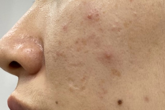 Làm gì khi mọc mụn nội tiết tố?