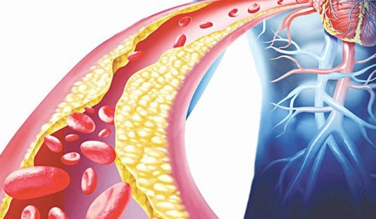 3 lý do khiến người cao tuổi dễ bị mỡ máu cao và cách khắc phục