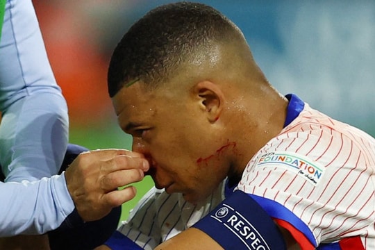 Mbappe phải phẫu thuật khẩn cấp vì bị gãy mũi, nguy cơ bỏ lỡ phần còn lại của EURO 2024