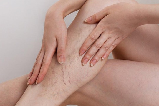Căn bệnh rình rập dân văn phòng, nghĩ đơn giản nhưng nguy cơ khó lường