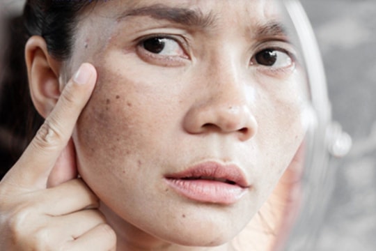 Mách bạn mẹo làm mờ vết đồi mồi trên da nhanh chóng