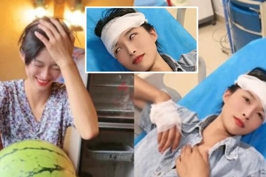 Cô gái dùng đầu đập vỡ dưa hấu, não bị chấn động