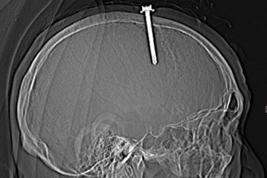 Suýt chết vì tự đóng cây đinh dài 5cm vào đầu mình