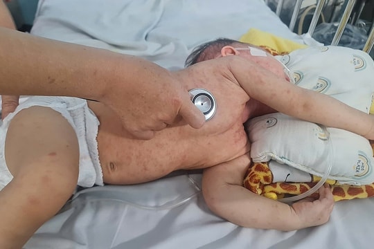Ca sởi tăng nhanh, TP Hồ Chí Minh thiếu thuốc cấp cứu trẻ bệnh nặng