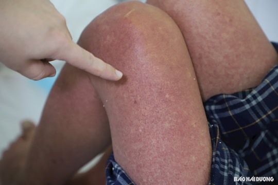 Một bệnh nhân quê Thanh Hà bị tổn thương gan sau mắc sốt xuất huyết