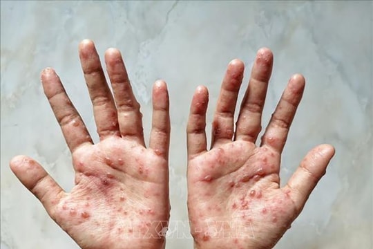 Philippines phát hiện thêm 3 ca mắc bệnh đậu mùa khỉ