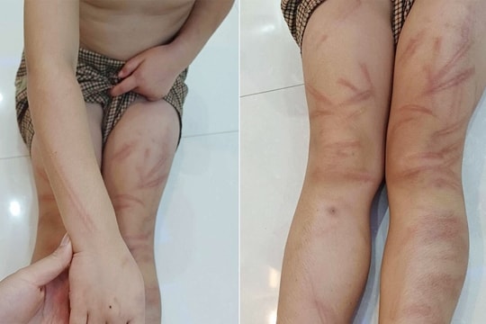 Làm rõ vụ việc 6 trẻ mầm non ở Nghệ An bị đánh bầm tím khắp cơ thể