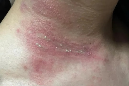 Nhiều người dính độc kiến ba khoang