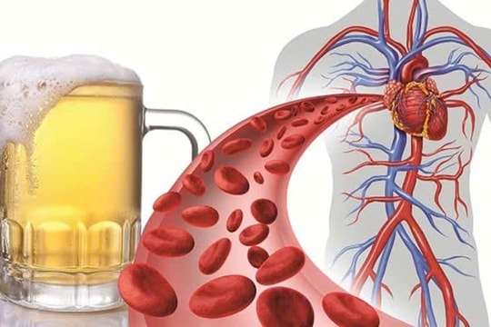 Rượu bia là “kẻ thù” với người tăng huyết áp