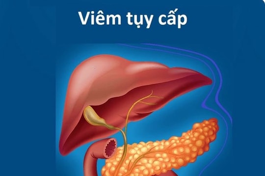 Uống rượu bia có thể mắc viêm tụy cấp gây tử vong nhanh chóng